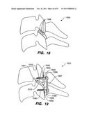 Apparatus for Sizing a Facet Joint diagram and image