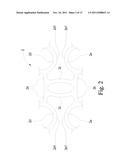 Preventing Vascular Stenosis of Cardiovascular Stent diagram and image