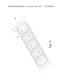 Preventing Vascular Stenosis of Cardiovascular Stent diagram and image