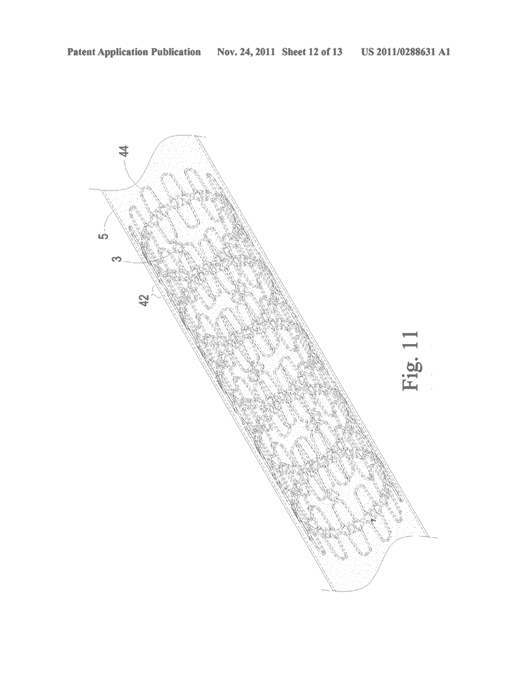 Preventing Vascular Stenosis of Cardiovascular Stent - diagram, schematic, and image 13