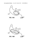 SYSTEMS AND METHODS FOR GASTRIC VOLUME REGULATION diagram and image