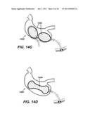 SYSTEMS AND METHODS FOR GASTRIC VOLUME REGULATION diagram and image