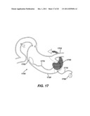 SYSTEMS AND METHODS FOR GASTRIC VOLUME REGULATION diagram and image