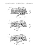 MINIMALLY INVASIVE MEDICAL DEVICE AND METHOD FOR DELIVERY OF THERAPEUTIC     OR DIAGNOSTIC AGENTS INTO A VESSEL WALL diagram and image
