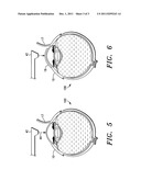 Laser-based methods and systems for corneal surgery diagram and image