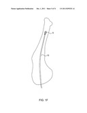 LAGWIRE SYSTEM AND METHOD FOR THE FIXATION OF BONE FRACTURES diagram and image