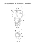 LAGWIRE SYSTEM AND METHOD FOR THE FIXATION OF BONE FRACTURES diagram and image