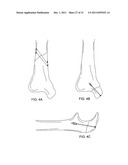 LAGWIRE SYSTEM AND METHOD FOR THE FIXATION OF BONE FRACTURES diagram and image