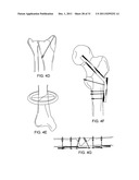 LAGWIRE SYSTEM AND METHOD FOR THE FIXATION OF BONE FRACTURES diagram and image