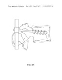 LAGWIRE SYSTEM AND METHOD FOR THE FIXATION OF BONE FRACTURES diagram and image