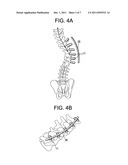 Methods for Correction of Spinal Deformities diagram and image