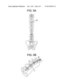 Methods for Correction of Spinal Deformities diagram and image