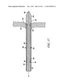 PROSTHESIS FOR RETRIEVAL AND DEPLOYMENT diagram and image