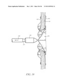 PROSTHESIS FOR RETRIEVAL AND DEPLOYMENT diagram and image