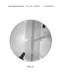 APPARATUS AND METHOD OF USING MARKERS TO POSITION STENTS IN BIFURCATIONS diagram and image