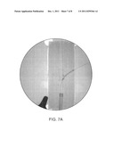 APPARATUS AND METHOD OF USING MARKERS TO POSITION STENTS IN BIFURCATIONS diagram and image