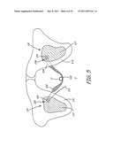 SACROCOLPOPEXY SUPPORT AND METHOD OF IMPLANTATION diagram and image