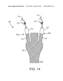 SACROCOLPOPEXY SUPPORT AND METHOD OF IMPLANTATION diagram and image