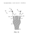 SACROCOLPOPEXY SUPPORT AND METHOD OF IMPLANTATION diagram and image