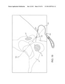 SACROCOLPOPEXY SUPPORT AND METHOD OF IMPLANTATION diagram and image