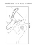 SACROCOLPOPEXY SUPPORT AND METHOD OF IMPLANTATION diagram and image