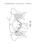 SACROCOLPOPEXY SUPPORT AND METHOD OF IMPLANTATION diagram and image