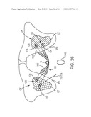 SACROCOLPOPEXY SUPPORT AND METHOD OF IMPLANTATION diagram and image