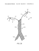 SACROCOLPOPEXY SUPPORT AND METHOD OF IMPLANTATION diagram and image