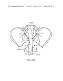 SACROCOLPOPEXY SUPPORT AND METHOD OF IMPLANTATION diagram and image