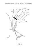 METHOD AND KIT FOR PREPARING A DENTAL ABUTMENT diagram and image