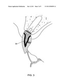 METHOD AND KIT FOR PREPARING A DENTAL ABUTMENT diagram and image