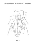 METHOD AND KIT FOR PREPARING A DENTAL ABUTMENT diagram and image