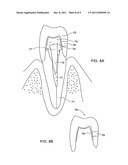 METHOD AND KIT FOR PREPARING A DENTAL ABUTMENT diagram and image