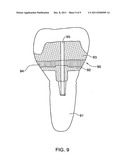 METHOD AND KIT FOR PREPARING A DENTAL ABUTMENT diagram and image