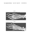 METHOD FOR TREATING AND PREVENTING ARTHRITIS diagram and image