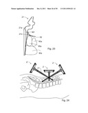 SURGICAL RETRACTOR diagram and image