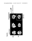 IMAGES OF LANGUAGE-SENSITIVE NEUROCIRCUITRY AS A DIAGNOSTIC FOR AUTISM diagram and image