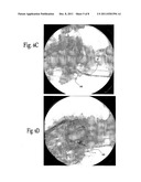 METHOD AND APPARATUS FOR THROMBUS DISSOLUTION/THROMBECTOMY BY AN ELECTRODE     CATHETER DEVICE diagram and image