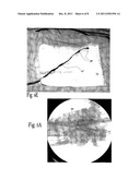 METHOD AND APPARATUS FOR THROMBUS DISSOLUTION/THROMBECTOMY BY AN ELECTRODE     CATHETER DEVICE diagram and image