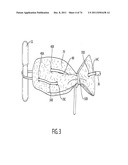 SELF-LOCKING CLOSURE DEVICE FOR PERCUTANEOUSLY SEALING PUNCTURES diagram and image