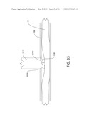 SELF-LOCKING CLOSURE DEVICE FOR PERCUTANEOUSLY SEALING PUNCTURES diagram and image