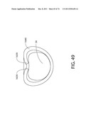 SELF-LOCKING CLOSURE DEVICE FOR PERCUTANEOUSLY SEALING PUNCTURES diagram and image