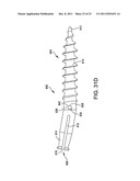 Hammer toe implant with expansion portion for retrograde approach diagram and image