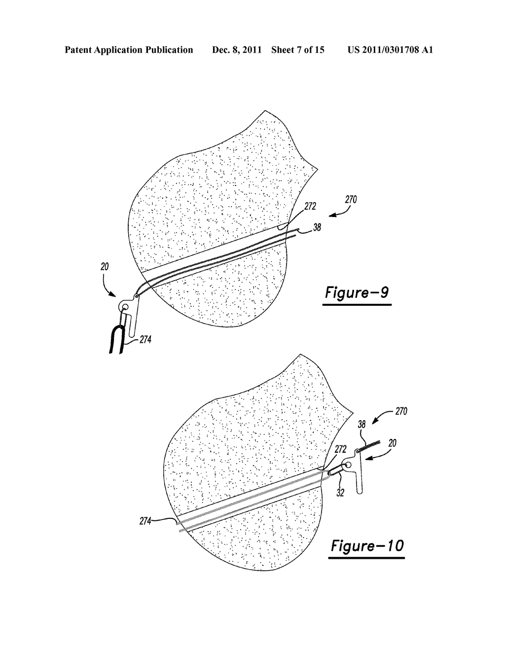 Method and Apparatus for Soft Tissue Fixation - diagram, schematic, and image 08