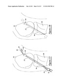 Method and Apparatus for Soft Tissue Fixation diagram and image