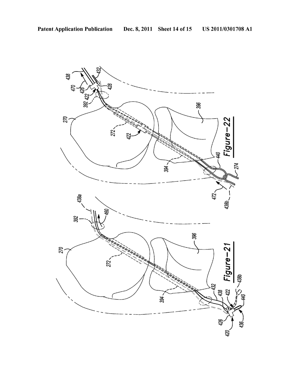 Method and Apparatus for Soft Tissue Fixation - diagram, schematic, and image 15