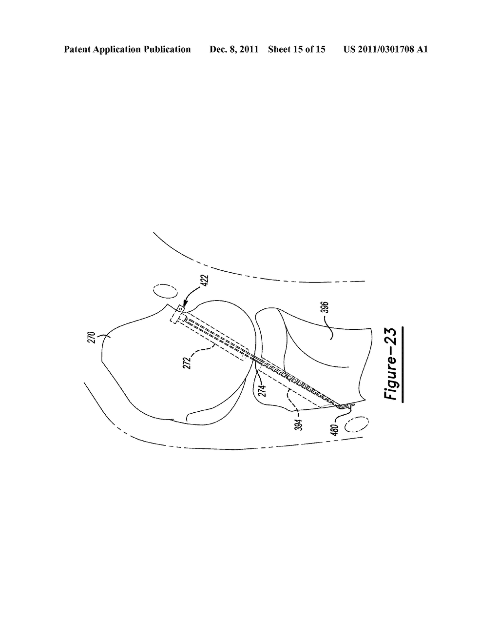 Method and Apparatus for Soft Tissue Fixation - diagram, schematic, and image 16