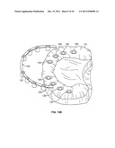 Components For Use With A Surgical Guide For Dental Implant Placement diagram and image