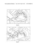 Components For Use With A Surgical Guide For Dental Implant Placement diagram and image