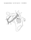 METHOD OF TREATING INCONTINENCE diagram and image